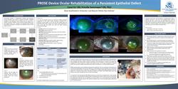 PROSE Device Ocular Rehabilitation of a Persistent Epithelial Defect